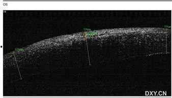 眼角膜充血图片,视觉健康警示图解